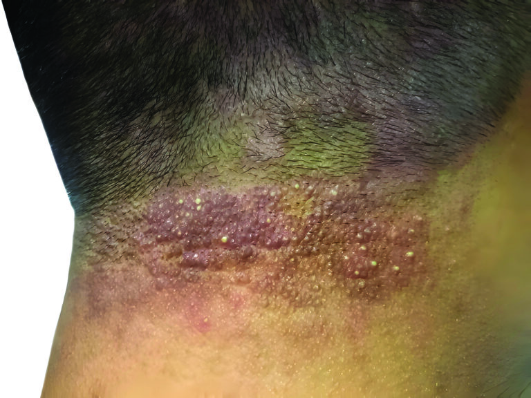 Folliculitis
