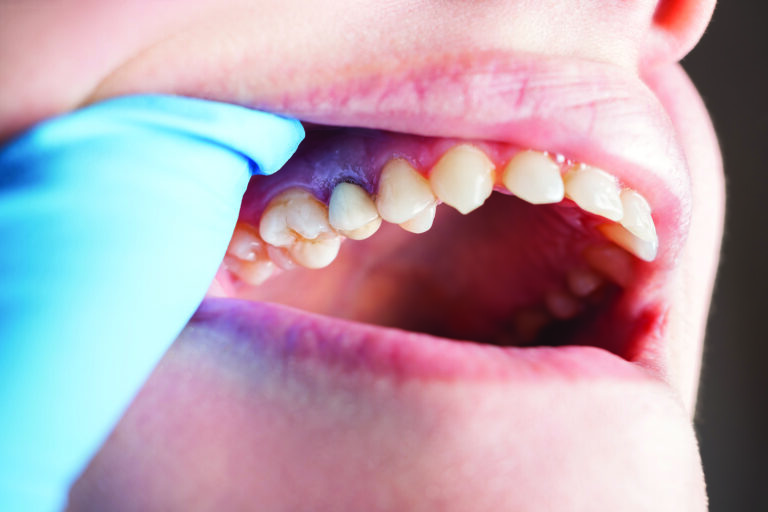 gum disease and heart disease