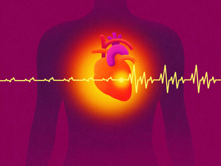 Heart Arrhythmia