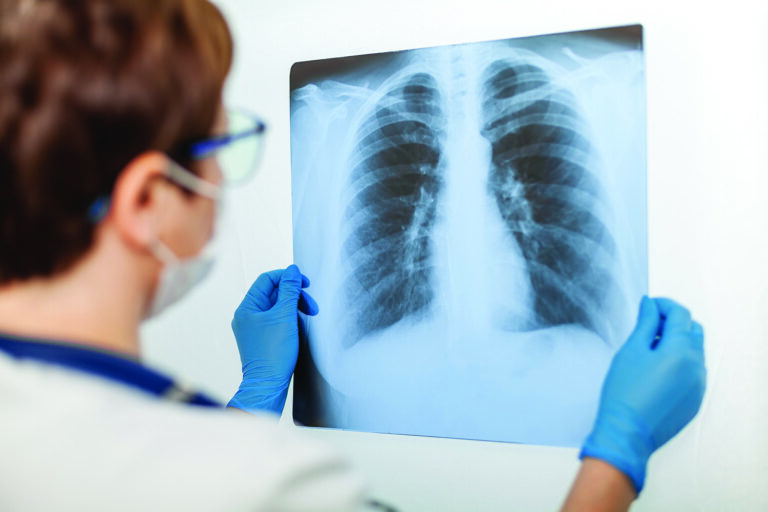 Bronchiectasis