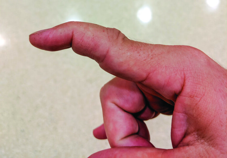 dislocated finger