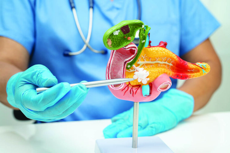 Pancreatic Cancer Symptoms
