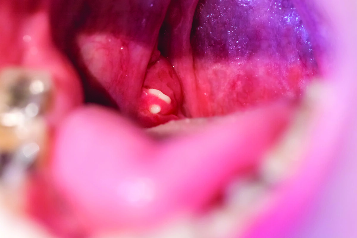 What Causes Tonsil Stones